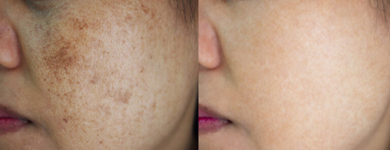 Before and after image